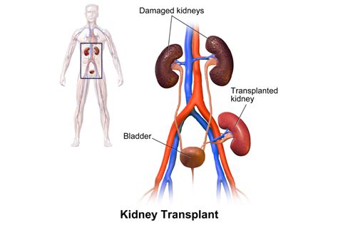 Kidney Transplant - Post Op Treatment in El Paso, TX