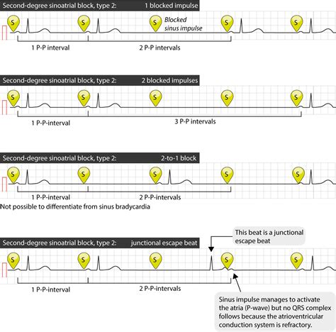 Sinus node dysfunction (SND) and sick sinus syndrome (SSS) – ECG learning