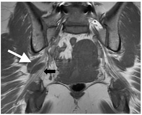 Sciatic Foramen Mri