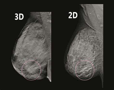 Southwest Health | 3D Digital Mammography