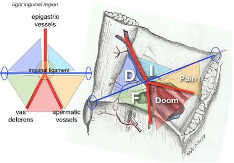 [PDF] SYSTEMIZATION OF LAPAROSCOPIC INGUINAL HERNIA REPAIR (TAPP) BASED ON A NEW ANATOMICAL ...