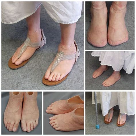 Toe & Foot Photo Gallery – Medical Art Prosthetics