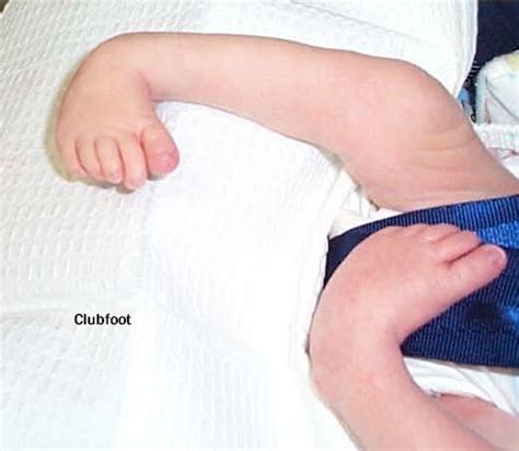 CTEV (Congenital Talipes Equinovarus) or Clubfoot | Treatment Zone