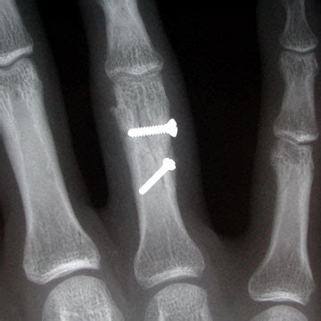 Phalanx Fracture ORIF 26735 | eORIF