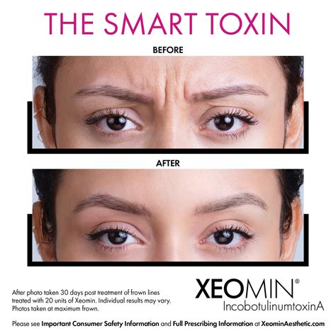 Botox & Xeomin | Chicago Skin Clinic | Botox Chicago