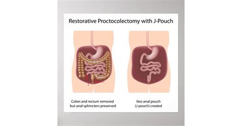 Restorative proctocolectomy surgery with j-pouch poster | Zazzle