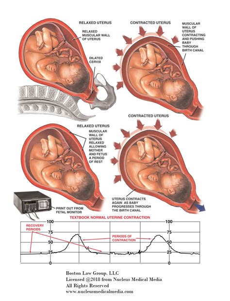 Understanding Uterine Contractions And HIE - HIE Resource Place