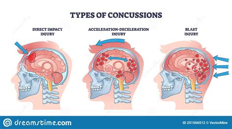 Concussion and Head Trauma or Injury Types from Medical View Outline Diagram Stock Vector ...