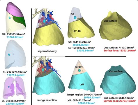 Segmentectomy or wedge resection of RS6. RIL: right inferior lung | Download Scientific Diagram