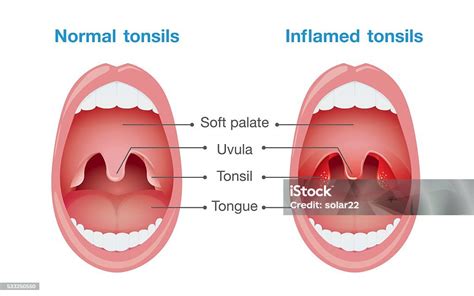 Normal Tonsils And Inflamed Tonsils Stock Illustration - Download Image ...