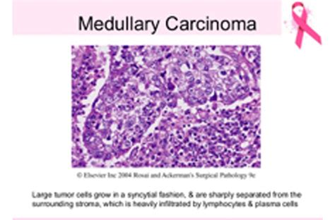 Medullary Carcinoma