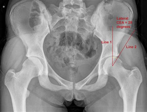 Lateral center-edge angle (CEA) on an anteroposterior pelvic radiograph... | Download Scientific ...