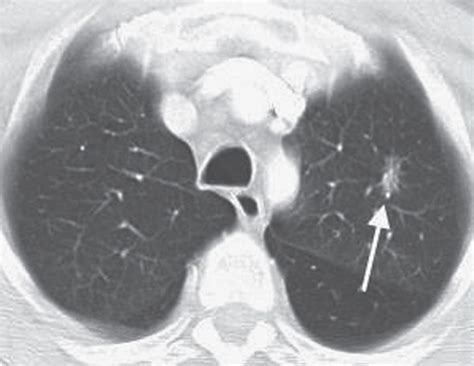 What Do Lung Nodules Look Like On Ct Scan Ct Scan Machine