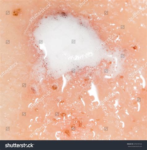 Wound On Human Skin Hydrogen Peroxide Stock Photo 679479724 | Shutterstock