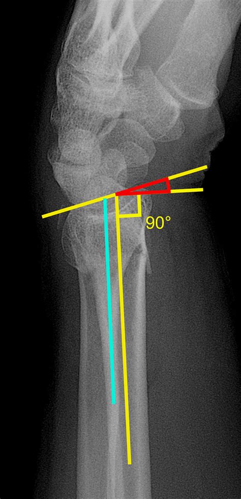 Distal Radius Fracture With Dorsal Angulation