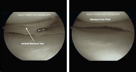 Meniscus Tear Surgery - Arthros