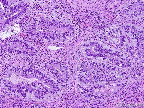 Invasive Adenocarcinoma of Lung