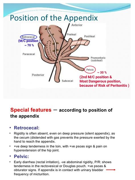 Position of Appendix ... #Most common #Retrocaecal #Pelvic General ...