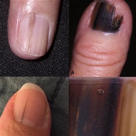 WHAT DOES NAIL MELANOMA LOOK LIKE? – Ani Michele Products