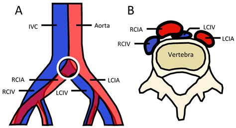 JCDD | Free Full-Text | Management of May Thurner Syndrome in Pregnant ...