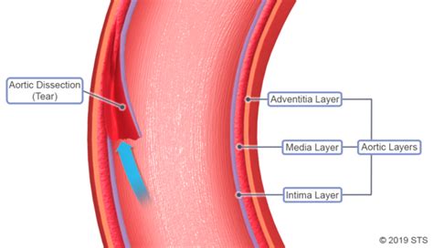 Aortic Dissection - Newport Cardiac & Thoracic Surgery