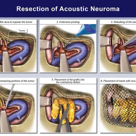 Acoustic Neuroma - TrialQuest Inc.