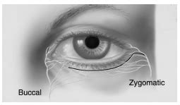 [Figure, Innervation of the Orbicularis Oculi...] - StatPearls - NCBI Bookshelf