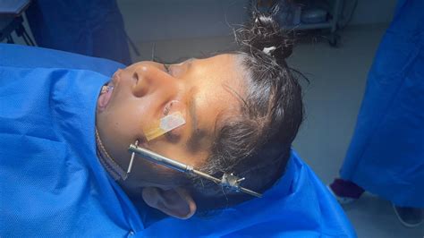 Lefort 3 distractor removal after 60mm new bone creation on the face ...