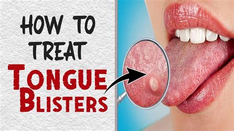 How to Treat Tongue Blisters Naturally | Home Remedies for Tongue Blisters Treatment - YouTube