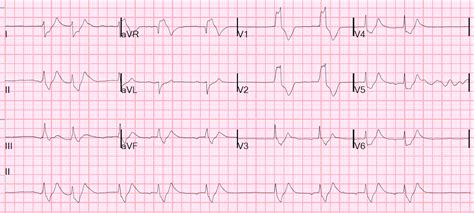 Dr. Smith's ECG Blog: A patient with cardiac arrest, ROSC, and right bundle branch block (RBBB).