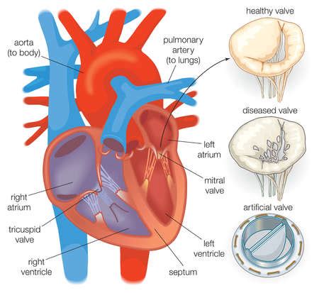 Stock Illustration - Diagram showing a healthy heart valve compared with a diseased heart valve ...