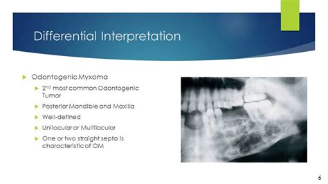 Odontogenic Myxoma - YouTube