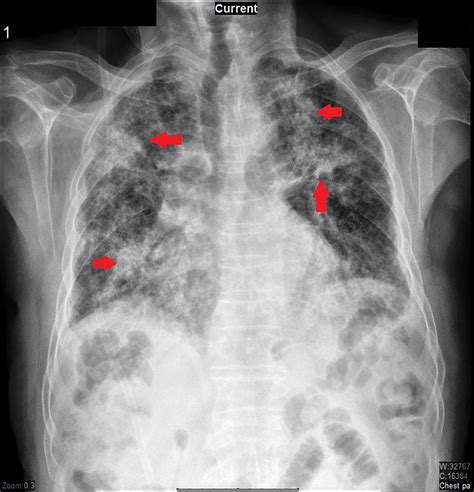 Cureus | Mycobacterium tuberculosis Infection in the Setting of ...