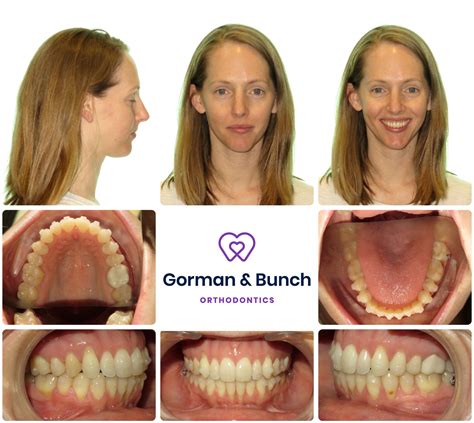 Invisalign Before and After Stories With Our Patients - Gorman & Bunch ...