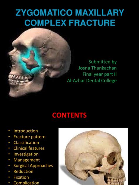 Zygomatico Maxillary Complex Fracture: Submitted by Josna Thankachan ...