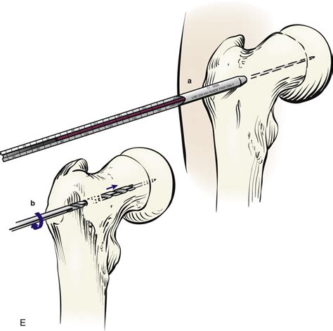 13 Percutaneous Cannulated Screw Fixation (“Pinning”) of Slipped Capital Femoral Epiphysis ...