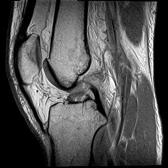 Knee MRI | Elite MRI of Michigan