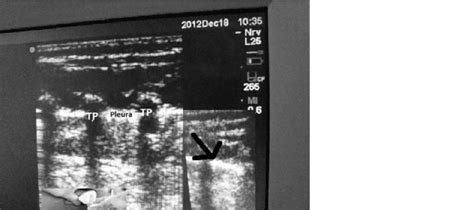 Ultrasound-guided paravertebral block in an 'out-of-plane' technique. | Download Scientific Diagram