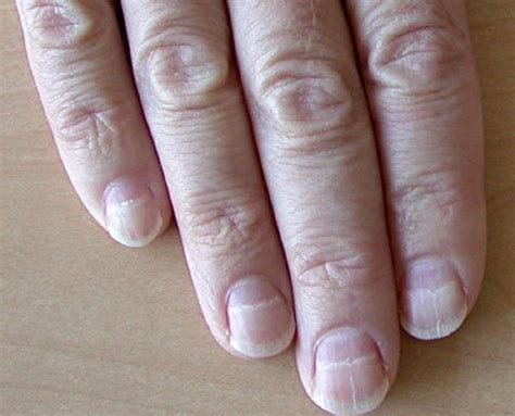 Muehrcke's nails - Medicalopedia