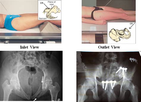 Pelvis-Inlet/Outlet View - Gundersen Health System - La Crosse ...