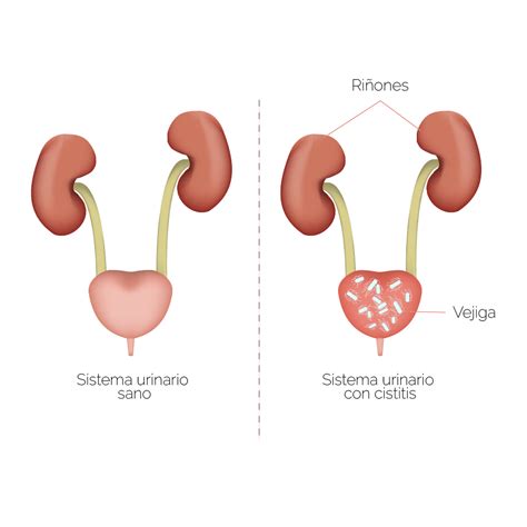 Infecciones urinarias