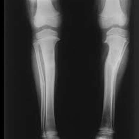 X-Ray Exam: Lower Leg (Tibia and Fibula) Test with Cost