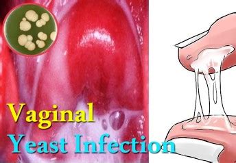 Understanding Vaginal Yeast Infections - Natural Yeast Infection Treatment