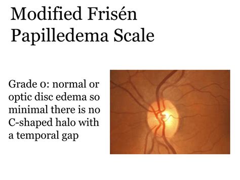 PPT - Idiopathic Intracranial Hypertension Treatment Trial Modified ...