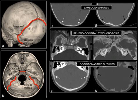 Lambdoid arch. 3D (a ,b) and 2D CT (c–h) starting at lambda, composed ...