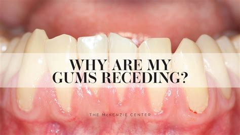 Tablo Read Receding Gums Symptoms Causes Treatment By - vrogue.co