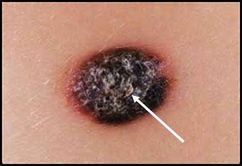 Could it be skin cancer? How to tell if a mole is cancerous - AOL