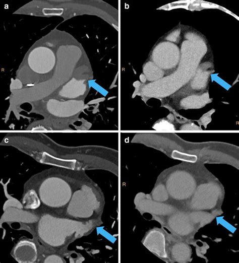 Representative examples of left atrial appendage thrombus (a, b) and ...