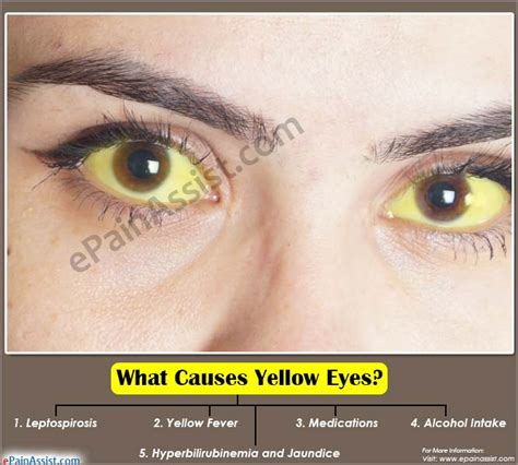 What Causes Yellow Eyes and Home Remedies to Get Rid of it?