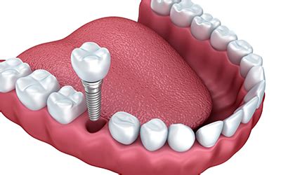 Dental Implant Surgery Side Effects